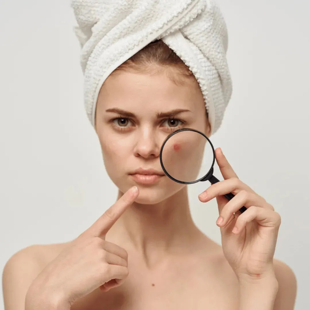 Sea of Spa - Acne Soap 125 gr Sea of SPA