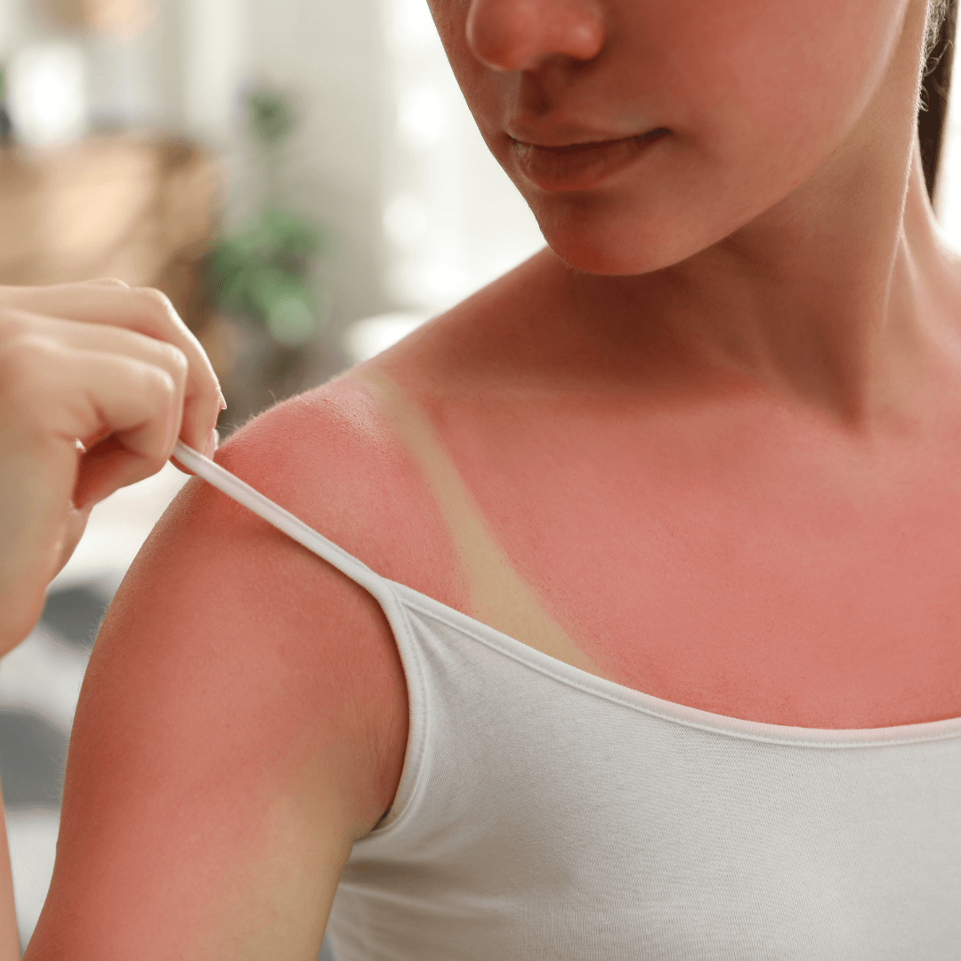 Woman with visible sunburn and tan lines on shoulder, skincare concern, WEDOART-IL