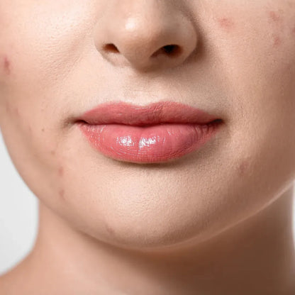 CeraVe Blamish Control Gel for treatment skin defects 40 ml CeraVe